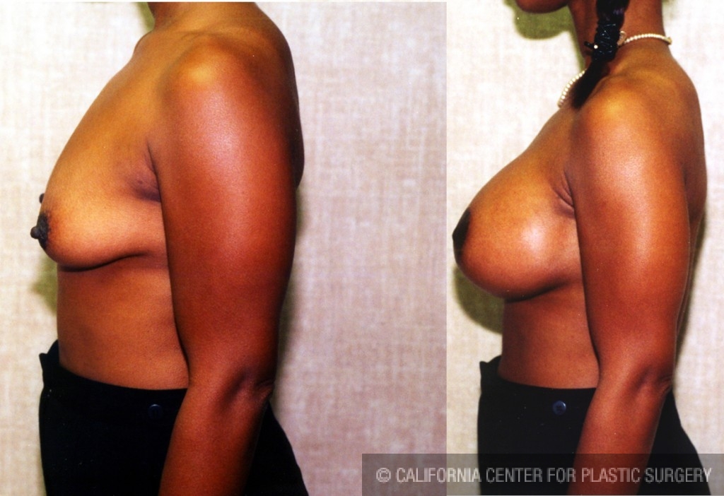 Breast Lift - Moderate Before & After Patient #6626