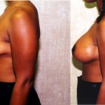 Breast Lift - Moderate Before & After Patient #6626