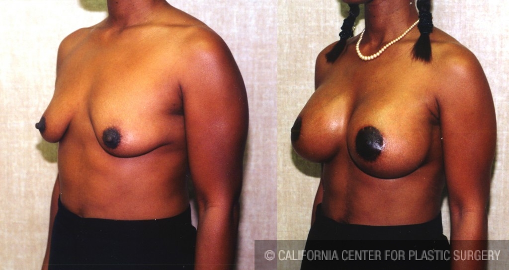 Breast Lift - Moderate Before & After Patient #6626