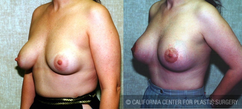Breast Lift - Moderate Before & After Patient #6638