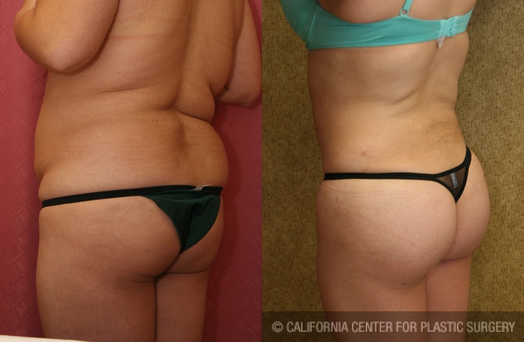 Buttock Lift/Augmentation Before & After Patient #6094