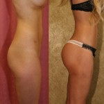 Buttock Lift/Augmentation Before & After Patient #6085