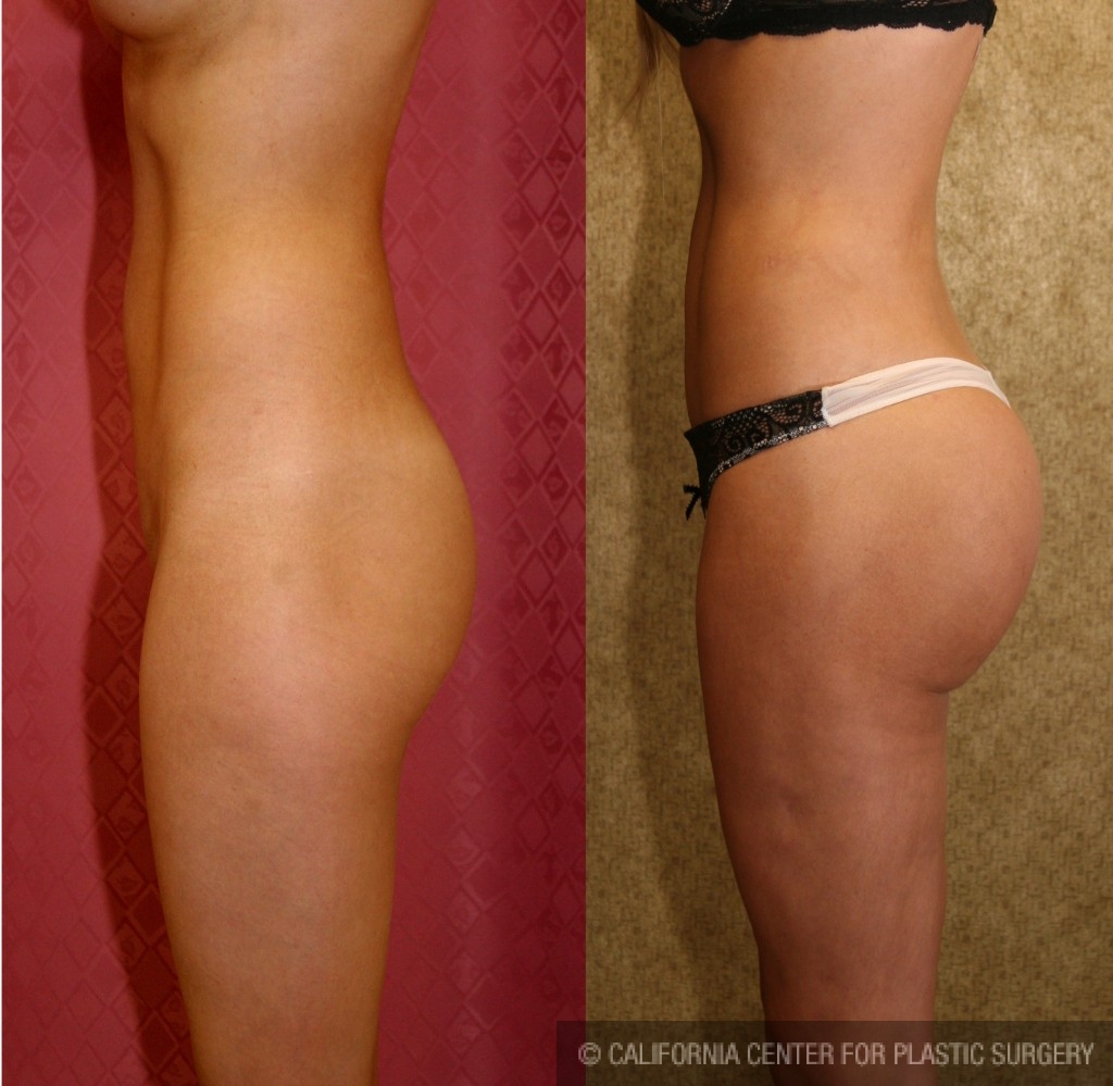 Patient #6085 Buttock Lift/Augmentation Before and After Photos