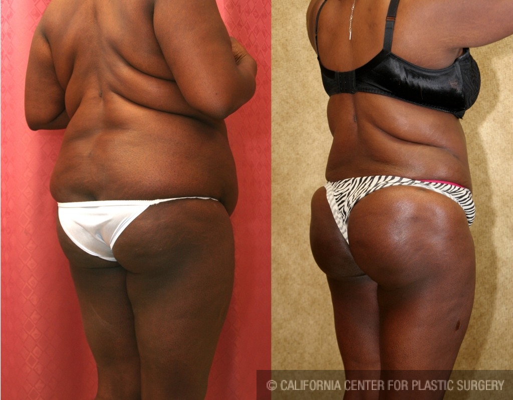 Buttock Lift/Augmentation Before & After Patient #6131