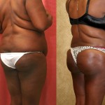 Buttock Lift/Augmentation Before & After Patient #6131