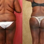 Buttock Lift/Augmentation Before & After Patient #6131