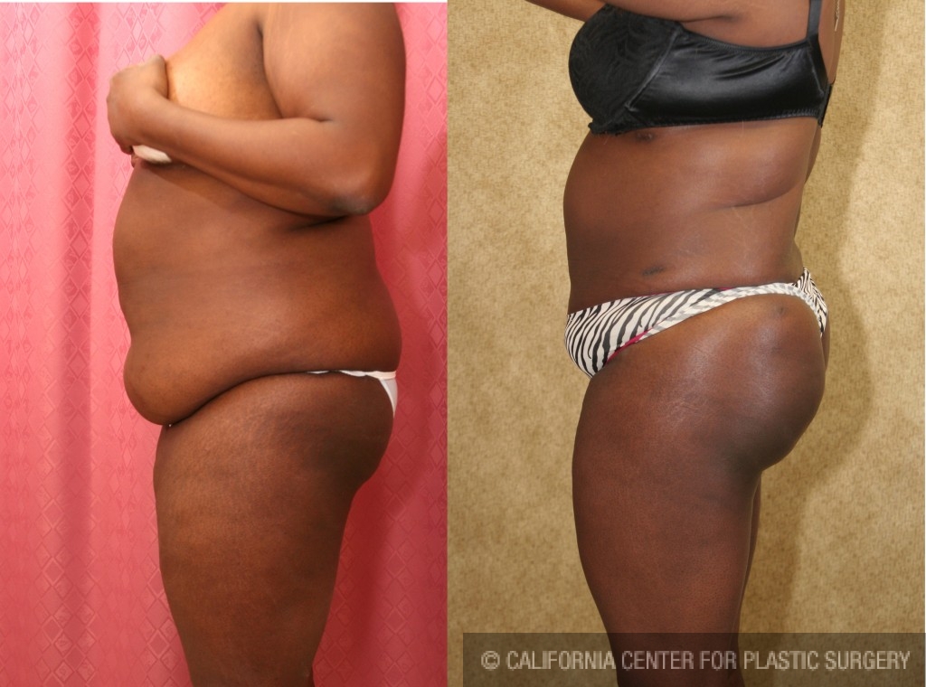 Buttock Lift/Augmentation Before & After Patient #6131