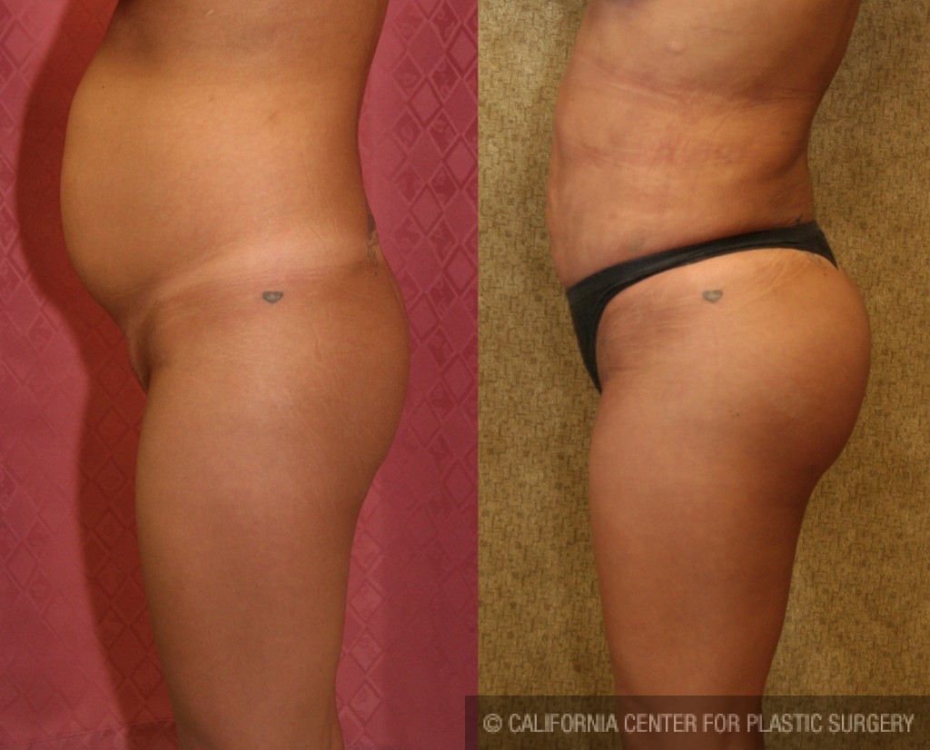 Buttock Lift/Augmentation Before & After Patient #6119