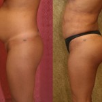 Buttock Lift/Augmentation Before & After Patient #6119