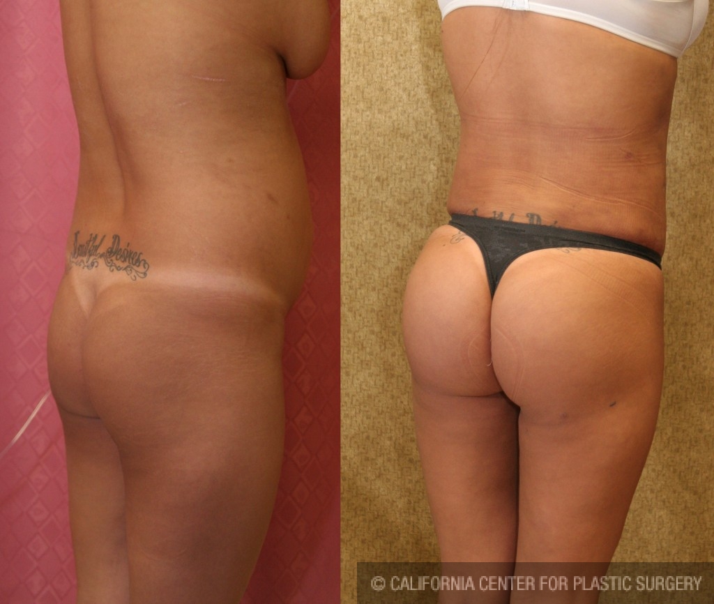 Buttock Lift/Augmentation Before & After Patient #6119