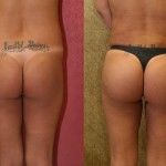 Buttock Lift/Augmentation Before & After Patient #6119