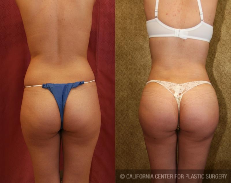 Buttock Lift/Augmentation Before & After Patient #6071