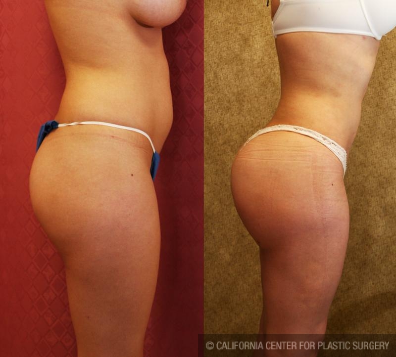 Buttock Lift/Augmentation Before & After Patient #6071