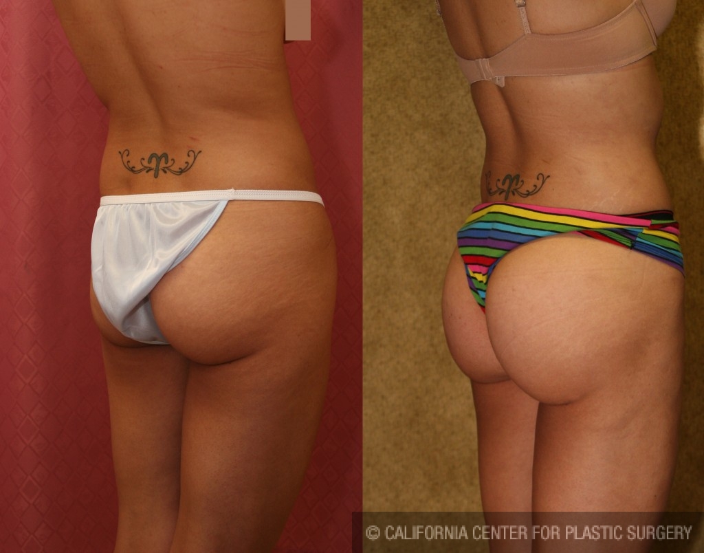 Buttock Lift/Augmentation Before & After Patient #6109