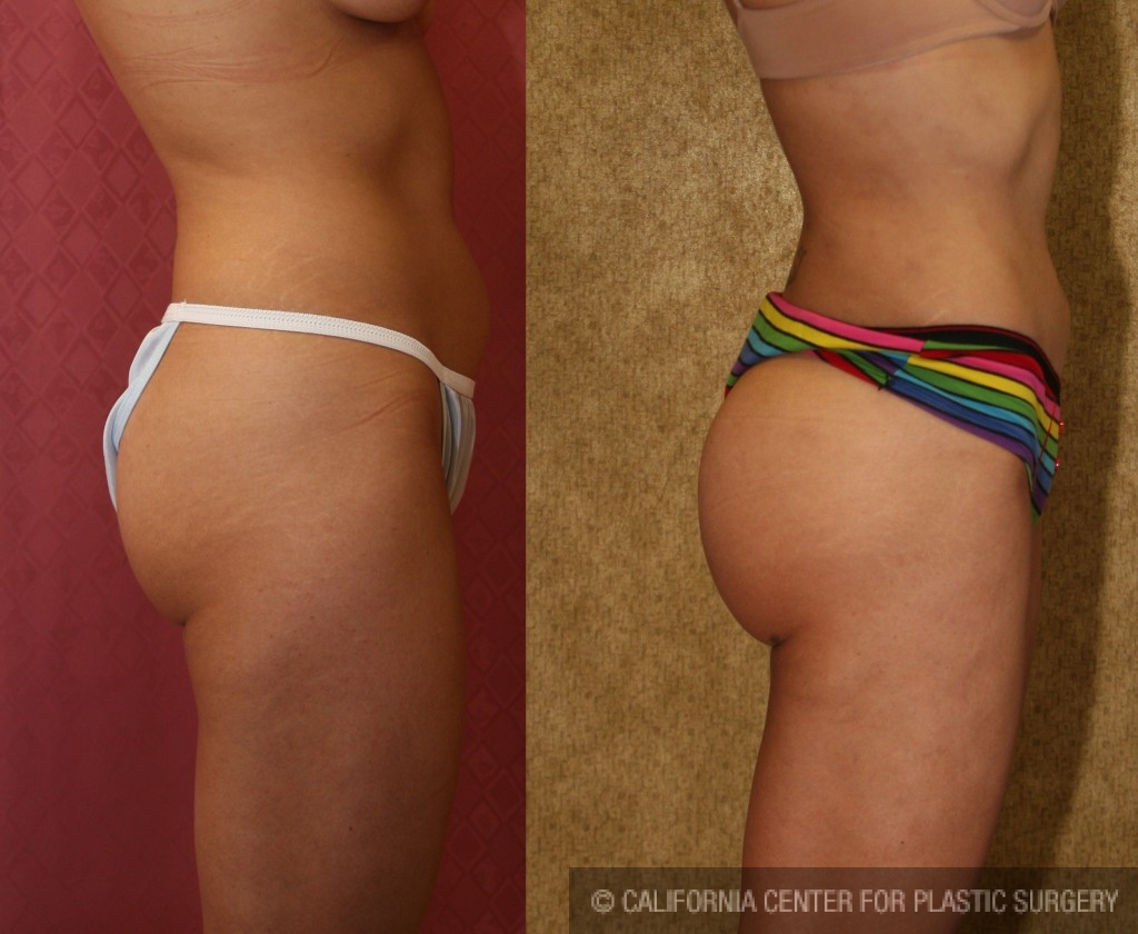 Buttock Lift/Augmentation Before & After Patient #6109