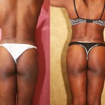 Buttock Lift/Augmentation Before & After Patient #6142