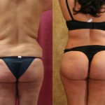 Buttock Lift/Augmentation Before & After Patient #6152