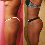 Buttock Lift/Augmentation Before & After Patient #6142
