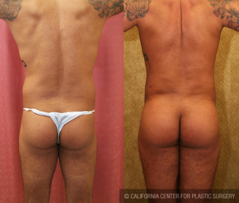 Buttock Lift/Augmentation Before & After Patient #6089