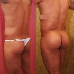 Buttock Lift/Augmentation Before & After Patient #6089