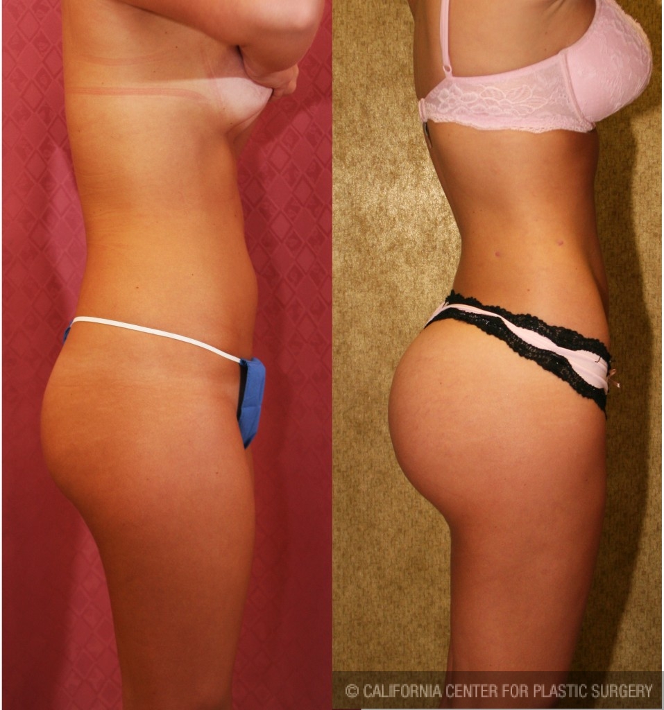 Buttock Lift/Augmentation Before & After Patient #6065