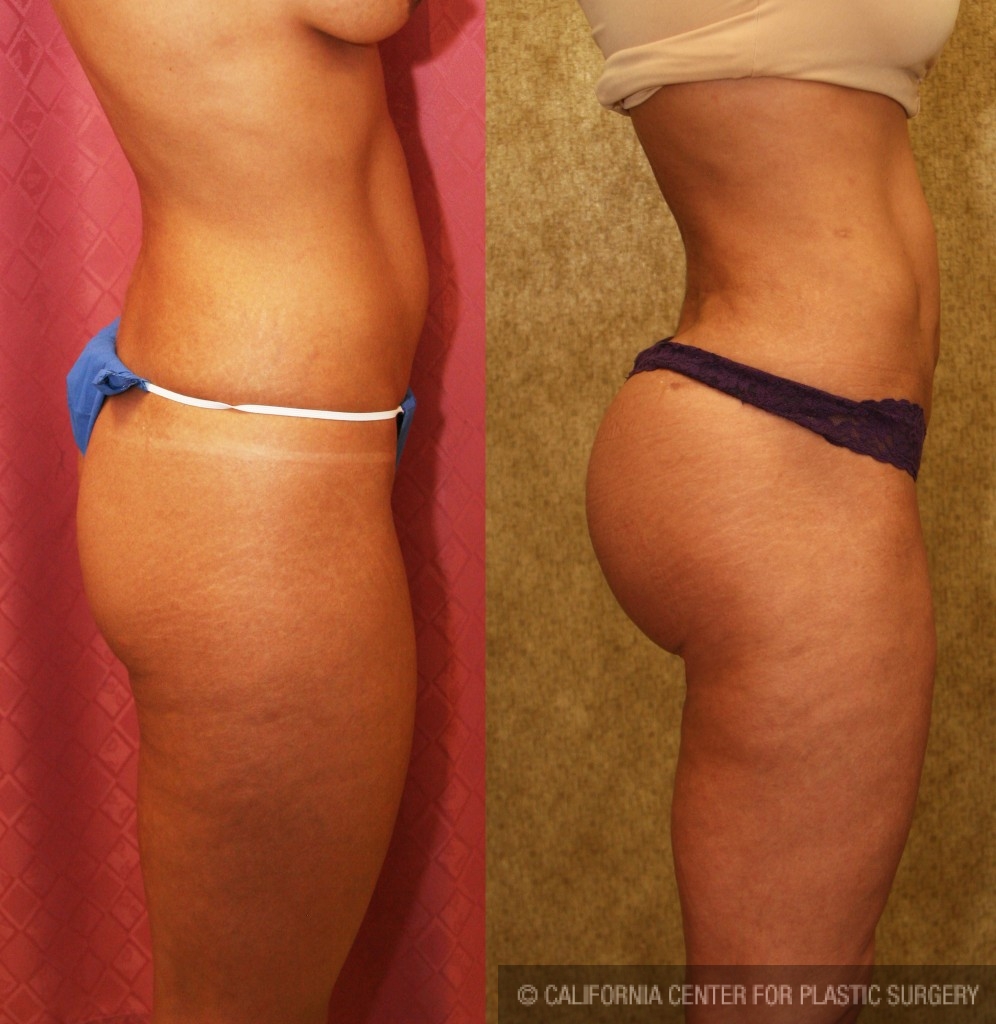 Buttock Lift/Augmentation Before & After Patient #6079