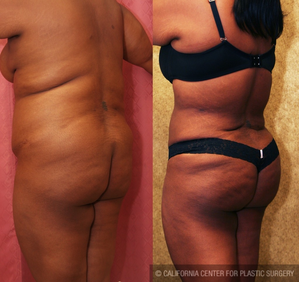 Buttock Lift/Augmentation Before & After Patient #6124