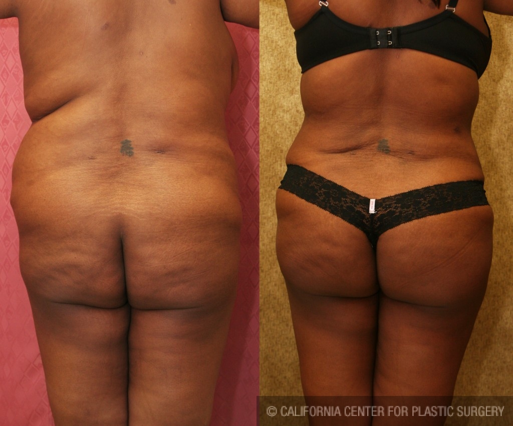 Buttock Lift/Augmentation Before & After Patient #6124