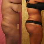 Buttock Lift/Augmentation Before & After Patient #6124