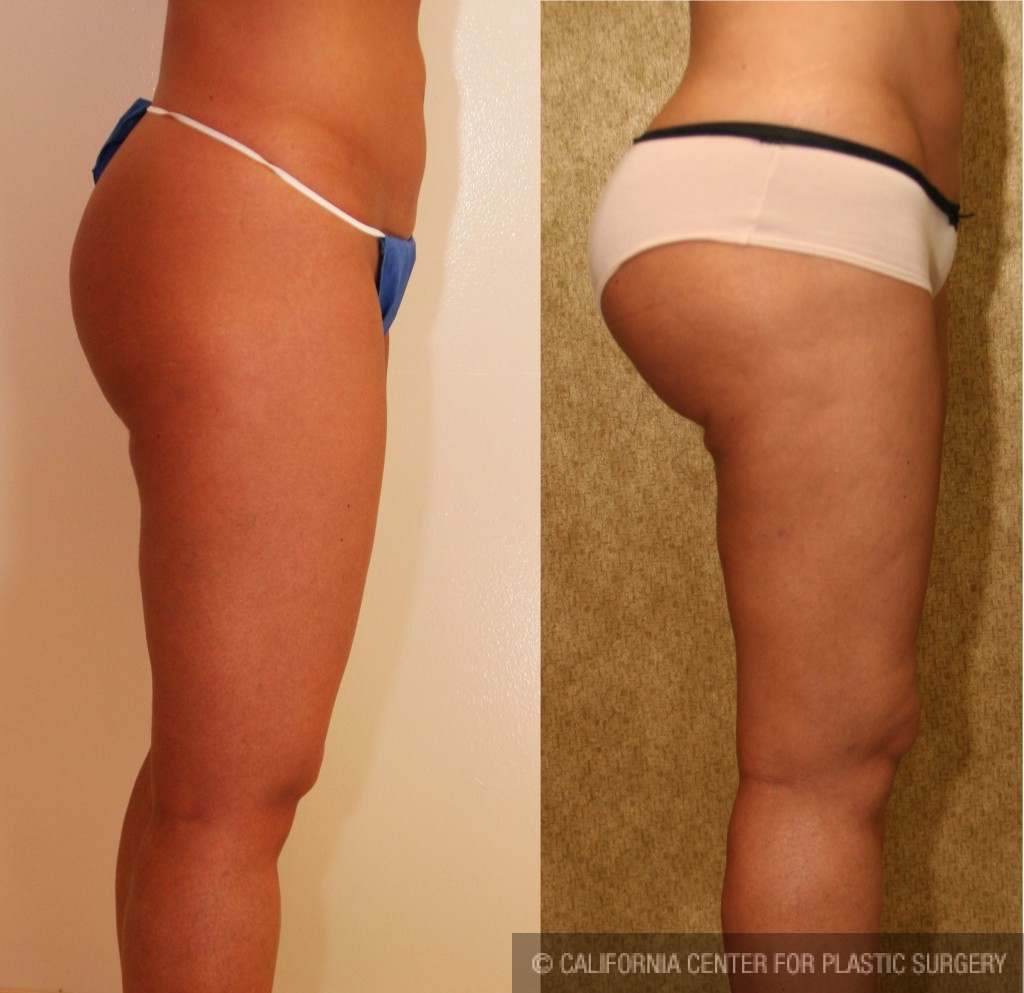 Buttock Lift/Augmentation Before & After Patient #6096