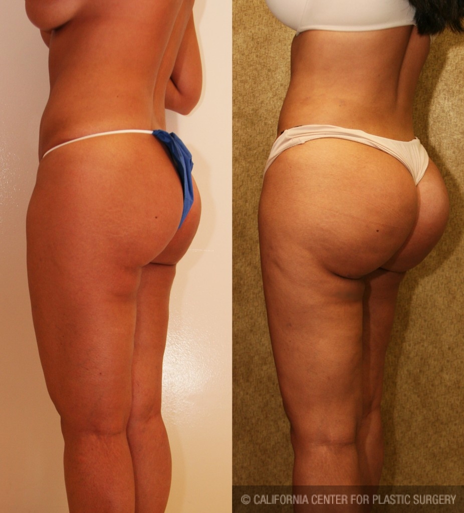 Buttock Lift/Augmentation Before & After Patient #6096