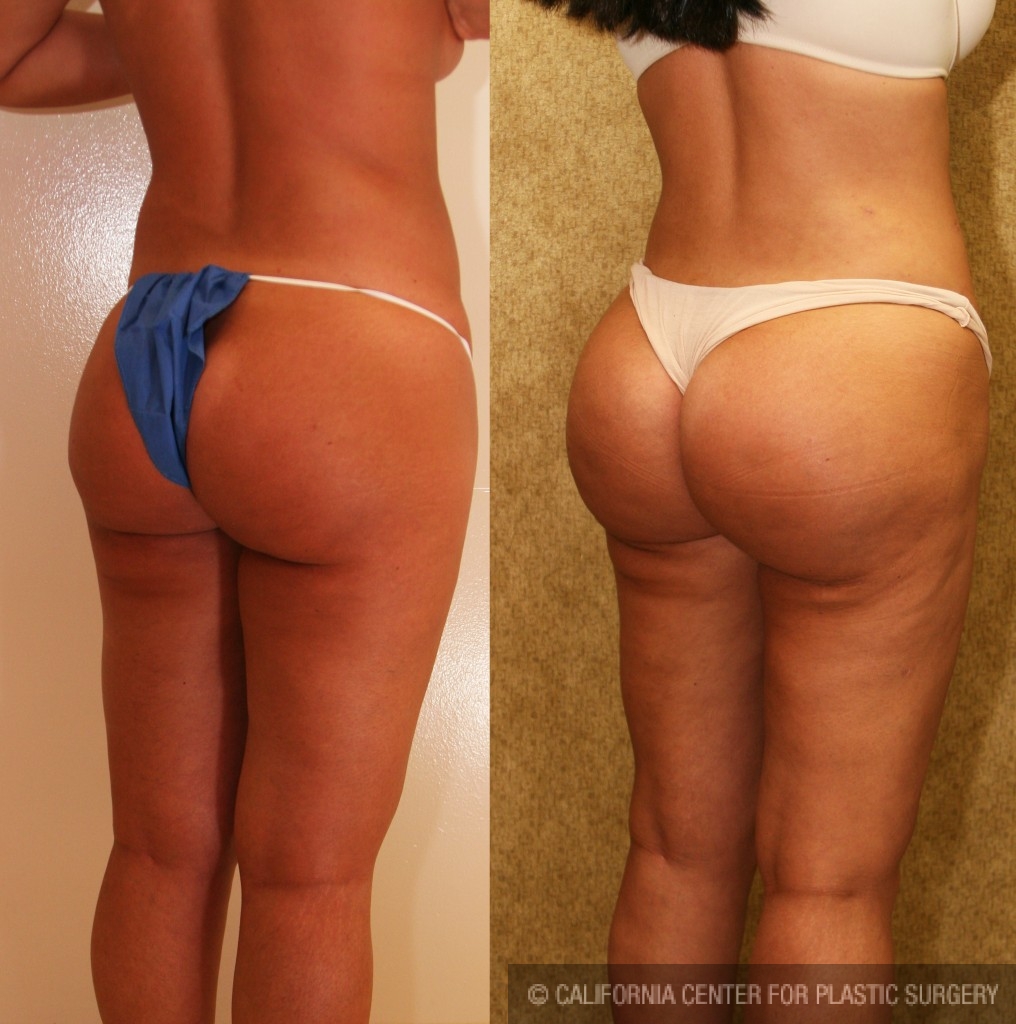 Buttock Lift/Augmentation Before & After Patient #6096