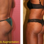 Buttock Lift/Augmentation Before & After Patient #6102