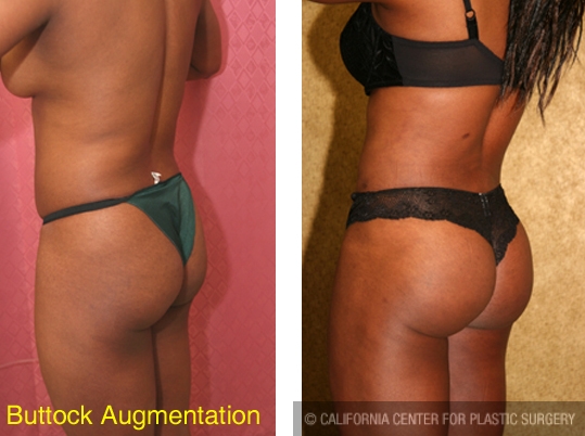 Patient #6102 Buttock Lift/Augmentation Before and After Photos