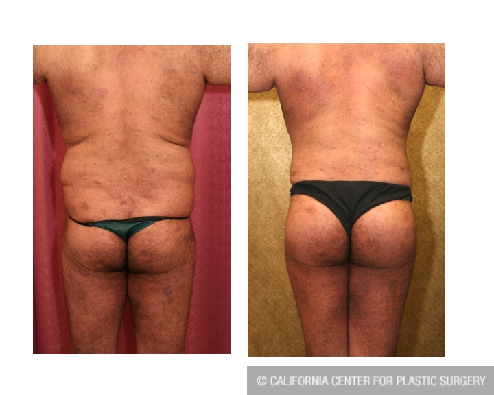 Patient #6116 Buttock Lift/Augmentation Before and After Photos