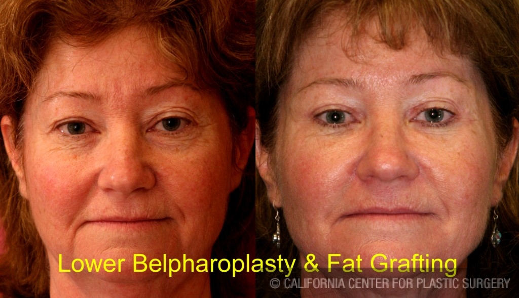 Eyelid (Blepharoplasty) Before & After Patient #6528