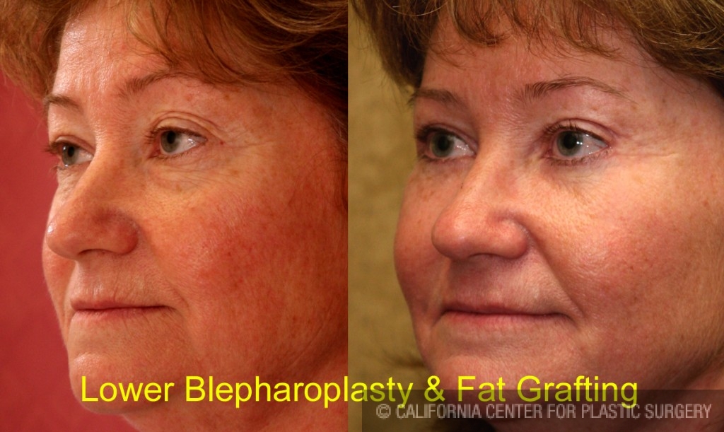 Facial Fat Grafting Before & After Patient #6746