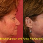 Facial Fat Grafting Before & After Patient #6746