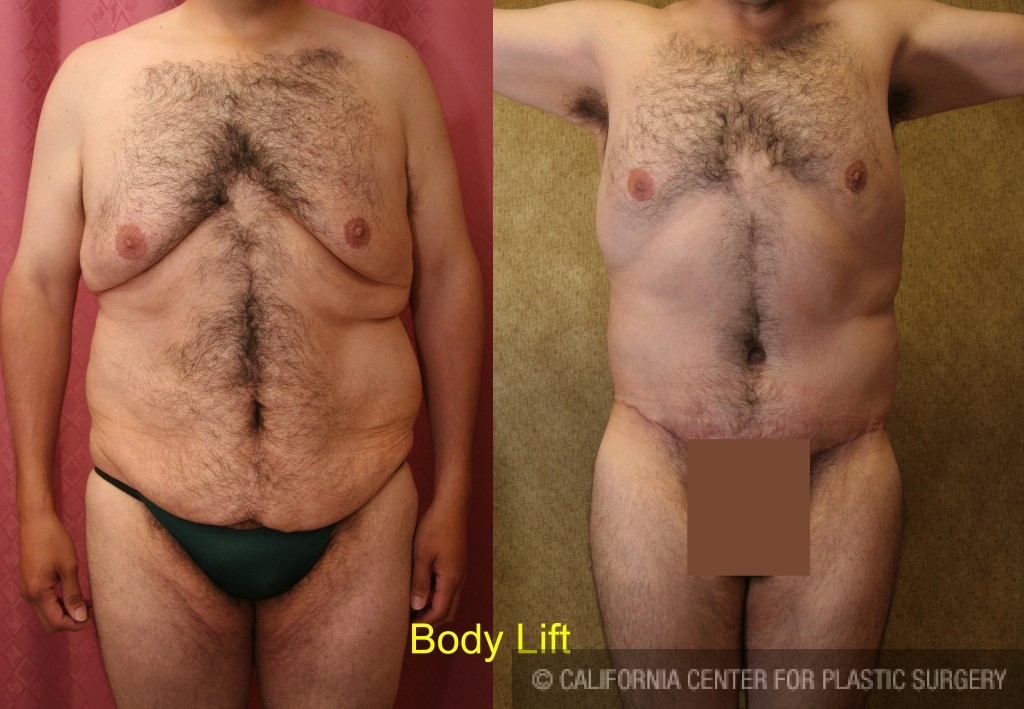 Male Tummy Tuck (abdominoplasty) Before & After Patient #6023