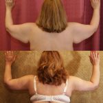 Arm Lift (Brachioplasty) Before & After Patient #6173