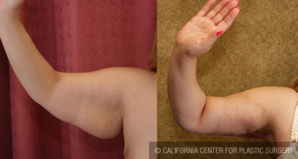 Arm Lift (Brachioplasty) Before & After Patient #6173