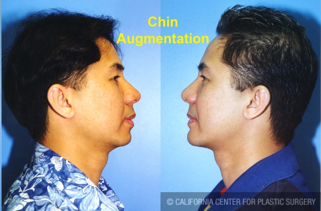 Chin Augmentation Before & After Patient #6799