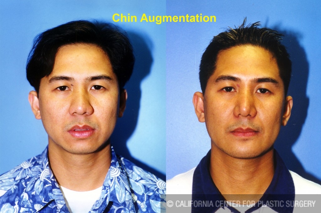 Chin Augmentation Before & After Patient #6799