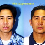 Chin Augmentation Before & After Patient #6799