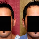 Ear (Otoplasty) Before & After Patient #6451