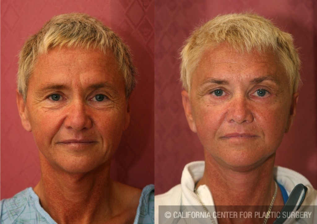 Eyelid (Blepharoplasty) Before & After Patient #6559