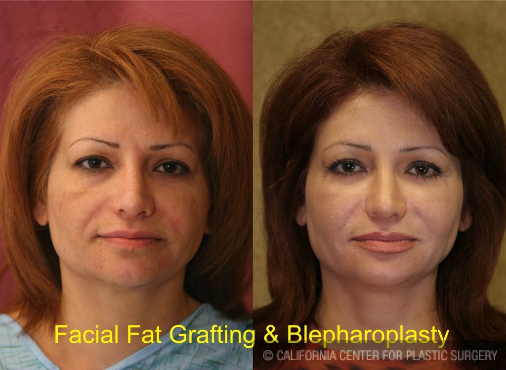 Facial Fat Grafting Before & After Patient #6757