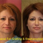 Facial Fat Grafting Before & After Patient #6757