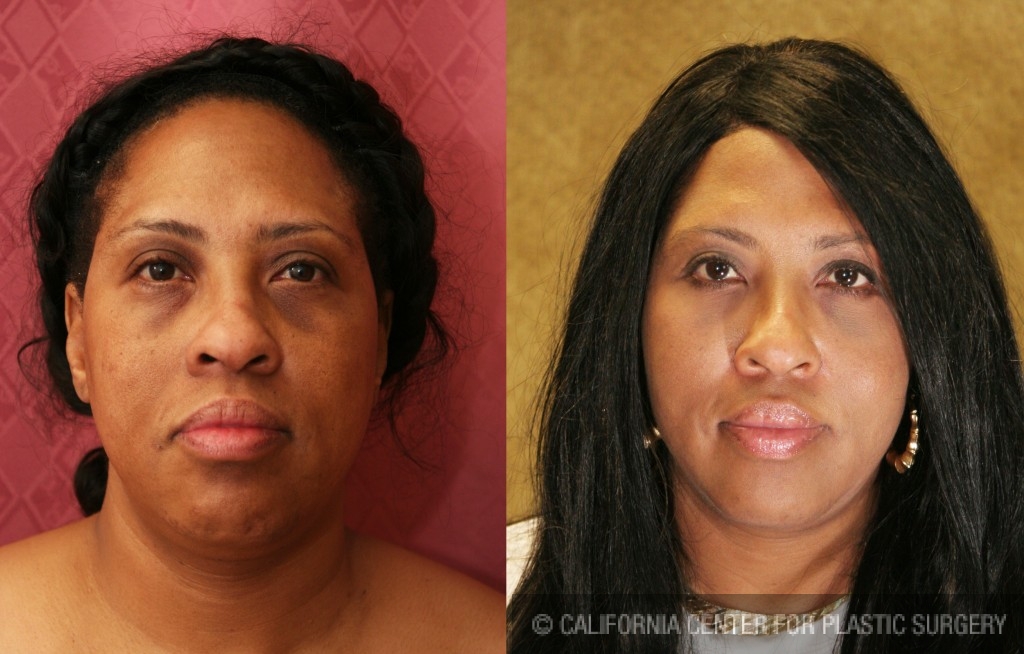 Eyelid (Blepharoplasty) Before & After Patient #6592