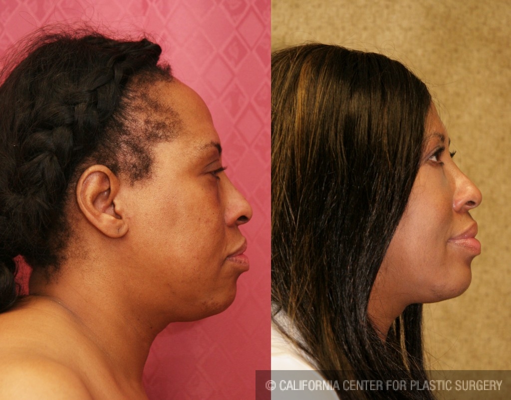 Eyelid (Blepharoplasty) Before & After Patient #6592